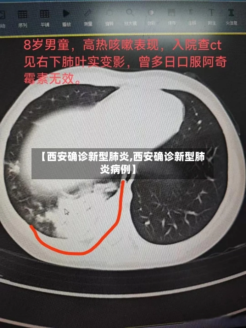 【西安确诊新型肺炎,西安确诊新型肺炎病例】-第1张图片