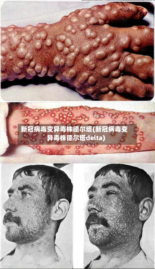 新冠病毒变异毒株德尔塔(新冠病毒变异毒株德尔塔delta)-第1张图片